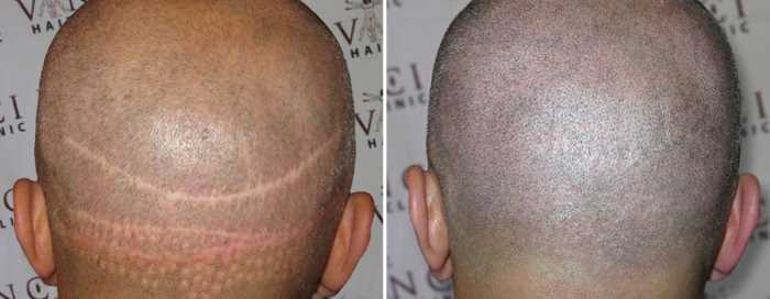 scalp pigmentation mod ar fra hårtransplantation